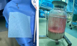 TPHCM: Người phụ nữ bị xương cá đâm thủng ruột, ổ bụng ngập mủ mà không hề hay biết