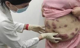 Quý bà 'tan nát' cơ thể vì mê làm đẹp cấp tốc