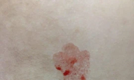 Bé gái 10 tuổi đột nhiên đổ mồ hôi máu