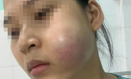 Bỏ tiền triệu 'nâng cấp sắc đẹp', thiếu nữ 'nhận' về gương mặt biến dạng 