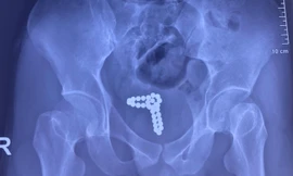 Nam thanh niên gặp nạn vì dùng chuỗi bi kim loại 'tự sướng'