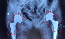 Nhiều người trẻ bị mục xương vì chất kích thích ai cũng dùng