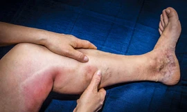 Căn bệnh có thể 'mất mạng', dấu hiệu cảnh báo chỉ từ sưng đau ở chân