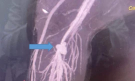 Bé trai suýt bị cắt cụt chân vì vết thương 'bé tí'