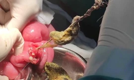 Bé gái thèm ăn tóc, tắc ruột vì hội chứng 'công chúa tóc mây'