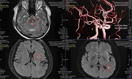 Doanh nhân trẻ đột quỵ vì thường xuyên tiếp đối tác bằng rượu bia