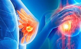 Bệnh viện Chợ Rẫy khám tầm soát miễn phí ung thư vú