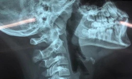 'Lạnh gáy' với cây kim dài ghim vào khí quản bé trai 10 tuổi