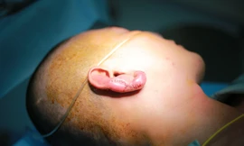 Tiêm chất làm đầy tạo tai Phật, người đàn ông suýt 'cụt tai'