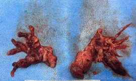 Nam bệnh nhân tắc cả 2 bên phổi hậu COVID-19