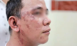 Hàng loạt bệnh nhân nhiễm loại độc gấp 15 lần nọc rắn hổ mang