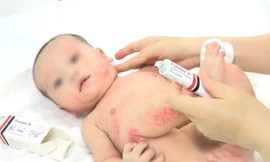Cha mẹ tự ý điều trị khiến trẻ bị hủy hoại làn da, lở loét, nhiễm trùng