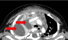 Bé 7 tháng tuổi nguy kịch vì nhiễm vi khuẩn 'vô địch kháng kháng sinh'
