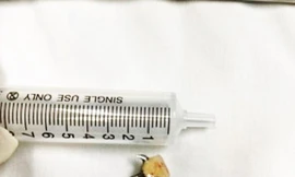 Chiếc răng giả 3 chân khiến nữ bệnh nhân gặp họa