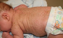 Bệnh vảy nến ở trẻ em ngày càng gia tăng