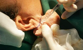 Nữ bệnh nhân bị dị dạng 'tai voi' vì sai lầm nhiều người hay mắc phải