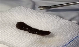 Con vắt sống trong mũi bé trai 18 tháng tuổi