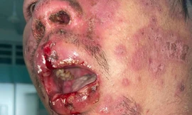 Toàn thân lở loét vì mắc bệnh lý hiếm gặp trên thế giới