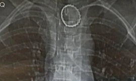 Uống nước ngọt, vô tình nuốt luôn cả nắp chai rồi... bỏ quên suốt 2 tháng