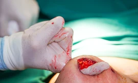 Tự tiêm thuốc tan mỡ, bụng bệnh nhân hoại tử trào mủ như 'núi lửa'