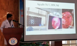 TPHCM: Hàng loạt trường hợp chết xương vùng đầu mặt hậu COVID-19