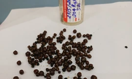 Nữ bệnh nhân mang hơn 200 viên sỏi trong đường mật