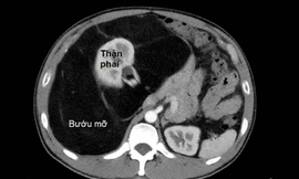 Người đàn ông 'chửa' với khối bướu mỡ khổng lồ hiếm gặp