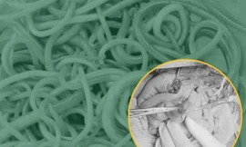 Bé trai hoại tử ruột, nguy kịch vì búi giun đũa cả trăm con