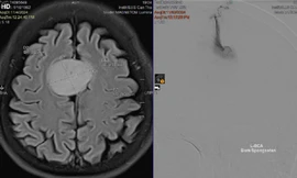 Người phụ nữ thoát 'án tử' u não nhờ... tai nạn giao thông