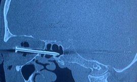 Tai nạn hi hữu: Thợ hồ bị đinh bắn xuyên hốc mắt 