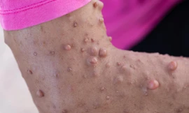 Khám sàng lọc miễn phí bệnh lý u sợi thần kinh