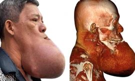 Cứu bệnh nhân bị 'nổ tung' khối u khổng lồ