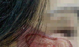 Quý bà nát hết mặt vì làm đẹp bằng dung dịch a xít