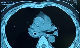 Ho ra máu suốt 20 năm vì nguyên nhân bất ngờ