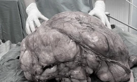Người đàn ông ở TPHCM mang 'bụng bầu' nặng gần 18kg