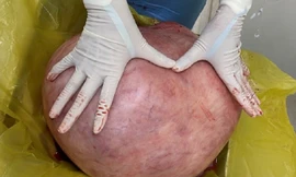 Nữ bệnh nhân nhiều năm mang u quái khổng lồ 11 kg vì nghĩ... mình mập