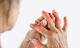 Pháp – Việt phối hợp tìm giải pháp trị dứt điểm bệnh gút