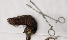 Búi tóc khoảng 1kg căng phồng chiếm trọn lòng dạ dày bé gái 5 tuổi