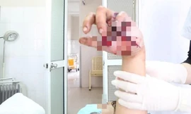 Thiếu niên bị nát bàn tay, lộ xương vì pháo tự chế