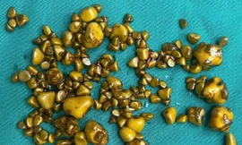 Người phụ nữ 'giấu cả trăm cục vàng' trong... túi mật