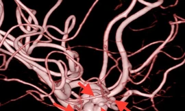 Nữ bệnh nhân bị cùng lúc 5 túi phình mạch máu não