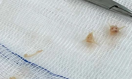 Xương lươn đâm xuyên thực quản khiến bé gái 10 tháng tuổi nguy kịch