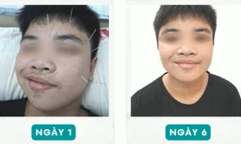 Bệnh 'khẩu nhãn oa tà' khiến nam sinh bất ngờ liệt nửa mặt