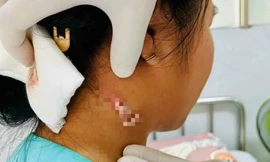 TPHCM: Phát hiện ca bệnh nhiễm 'vi khuẩn ăn thịt người' 