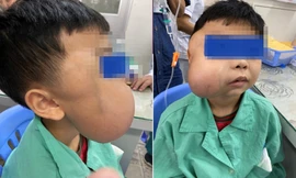 Bé trai bị khối u chiếm trọn khuôn mặt bên phải.
