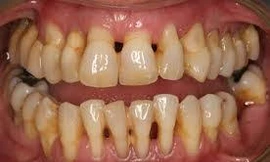 Một nỗ lực nghiên cứu mới đang hé lộ về mối liên hệ giữa Alzheimer và một căn bệnh không thể ngờ tới: bệnh nha chu.