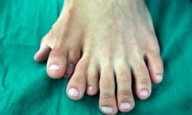 Người đàn ông có 9 ngón chân ở chân trái.