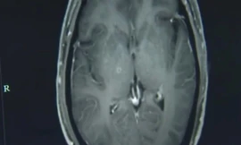 Hình ảnh chụp não cho thấy có hàng trăm con sán cư trú tại đó.