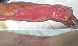 Vết thương nhỏ có thể gây chết người