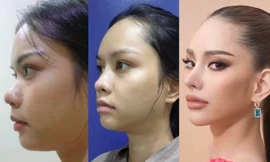 Tân Hoa hậu Hoàn vũ Thái Lan 2022 lộ ảnh trước khi phẫu thuật thẩm mỹ